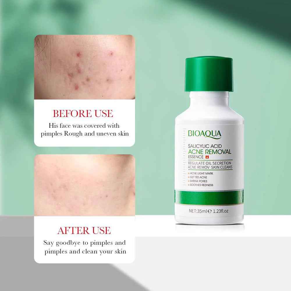 Bioaqua Salicylic Acid Acne Removal Serum
